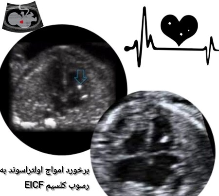 فوکوس اکوژن قلب جنین چیست؟